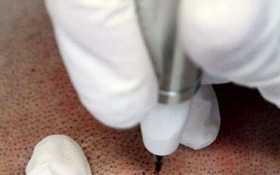 SCALP MICROPIGMENTATION – THE ADAPTABLE SEMI-PERMANENT HAIR LOSS TREATMENT