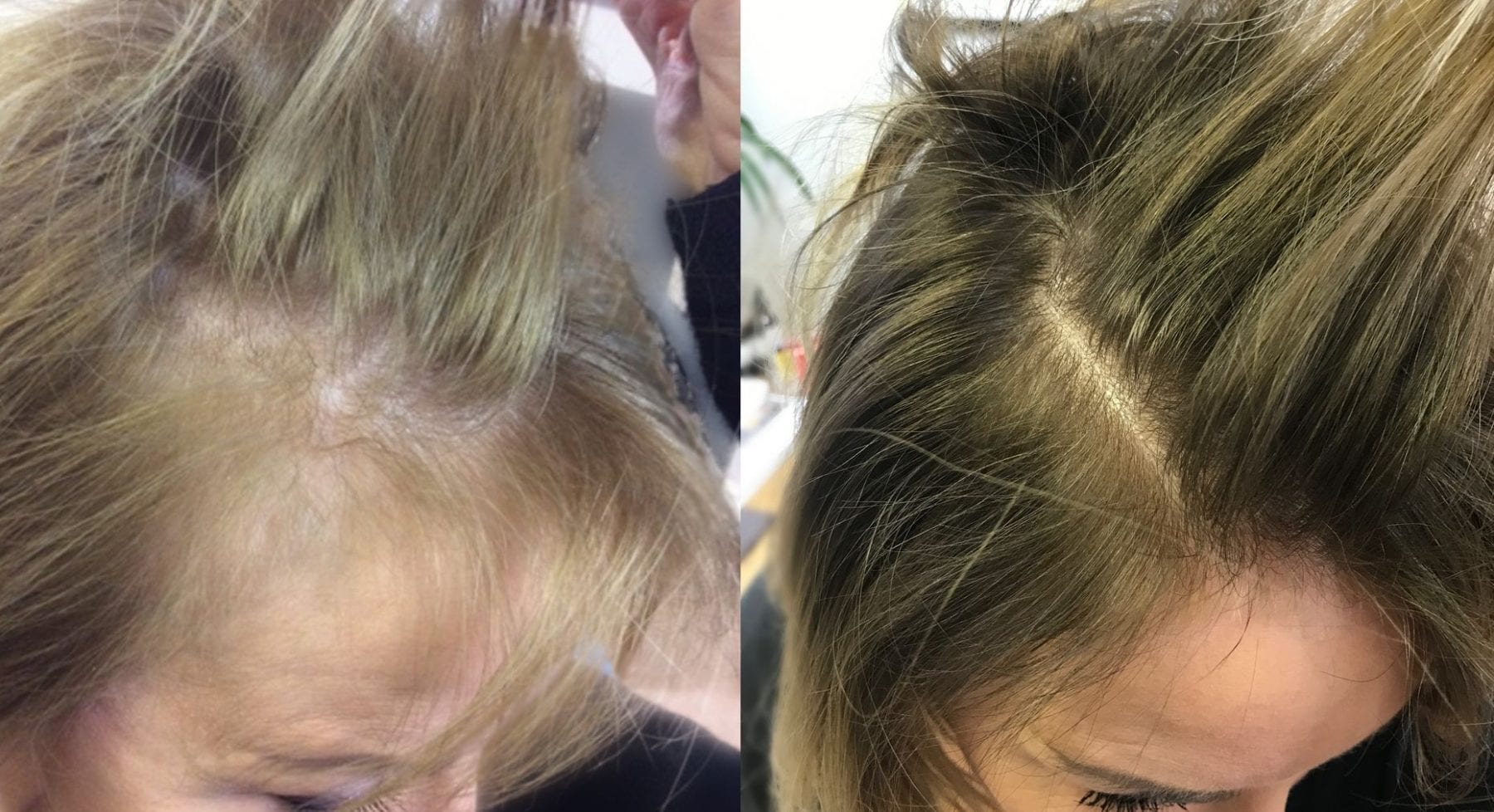 A portrait of a woman with well-defined facial features, likely demonstrating a positive outcome or confident look, suggesting specialized medical intervention can restore hair health successfully.