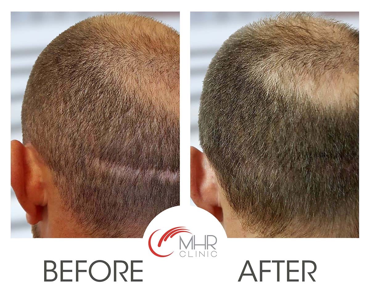 Back Up Blog Page | MHR Clinic | Hair Restoration Specialists