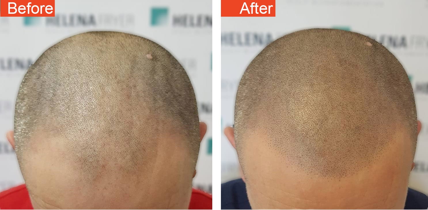 1 retouch
