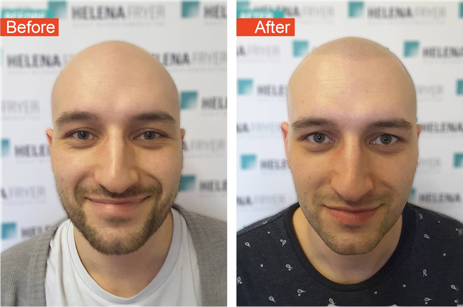 12 retouch michael vaughan hair restoration