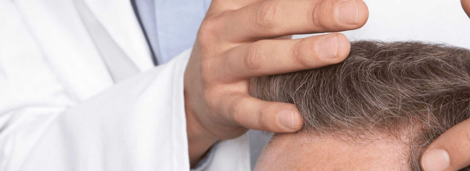 What to expect after a hair transplant What to expect after a hair transplant