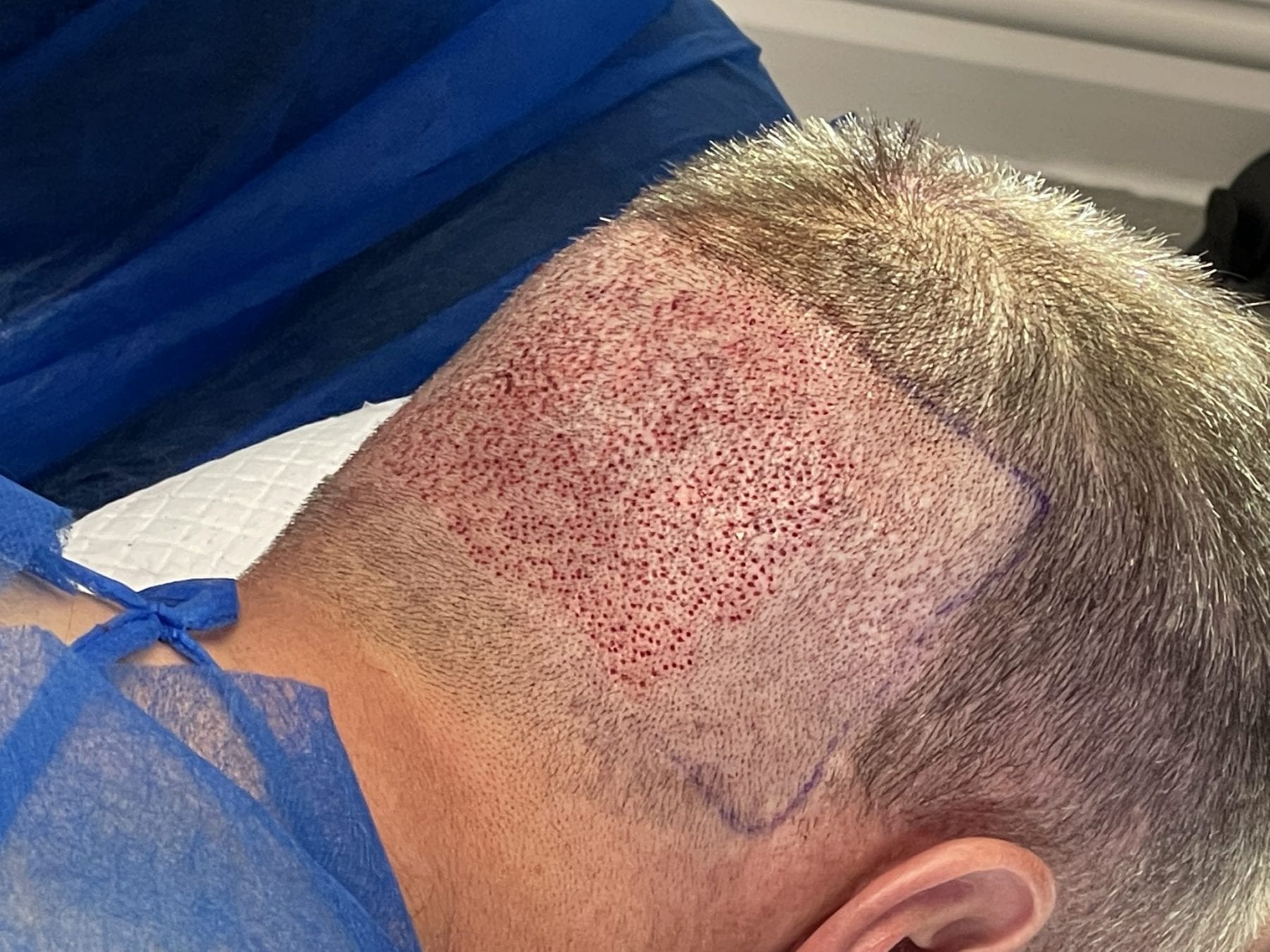 BLOG - Do hair transplants cause scarring - FUE donor area extraction (1)
