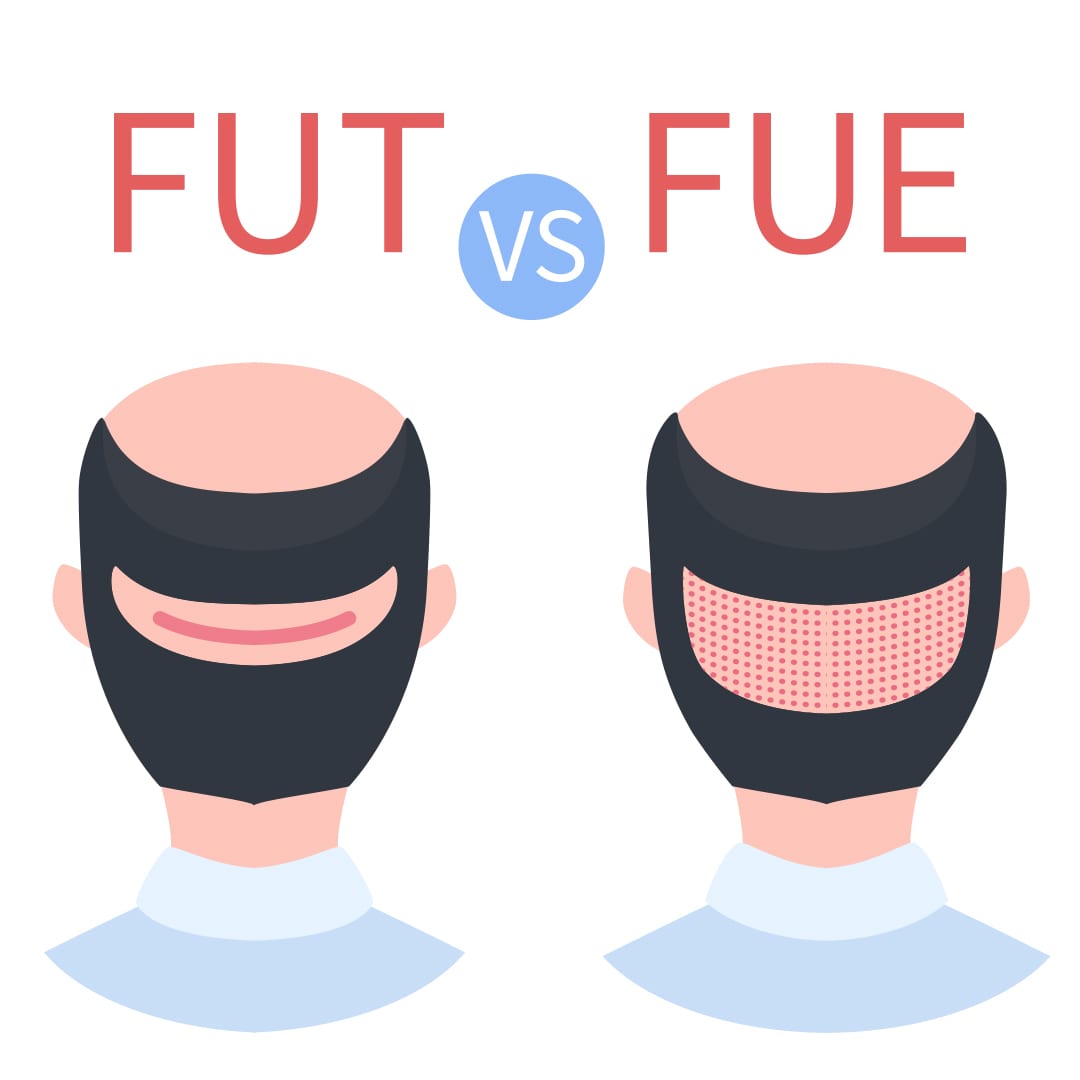 FUT vs FUE Diagram Nutrient Deficiency causes hair loss