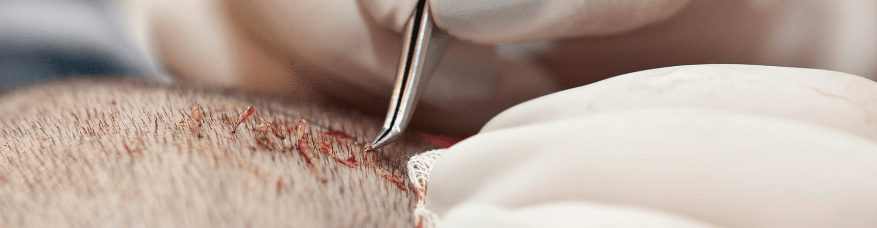 Hair transplant scaring results