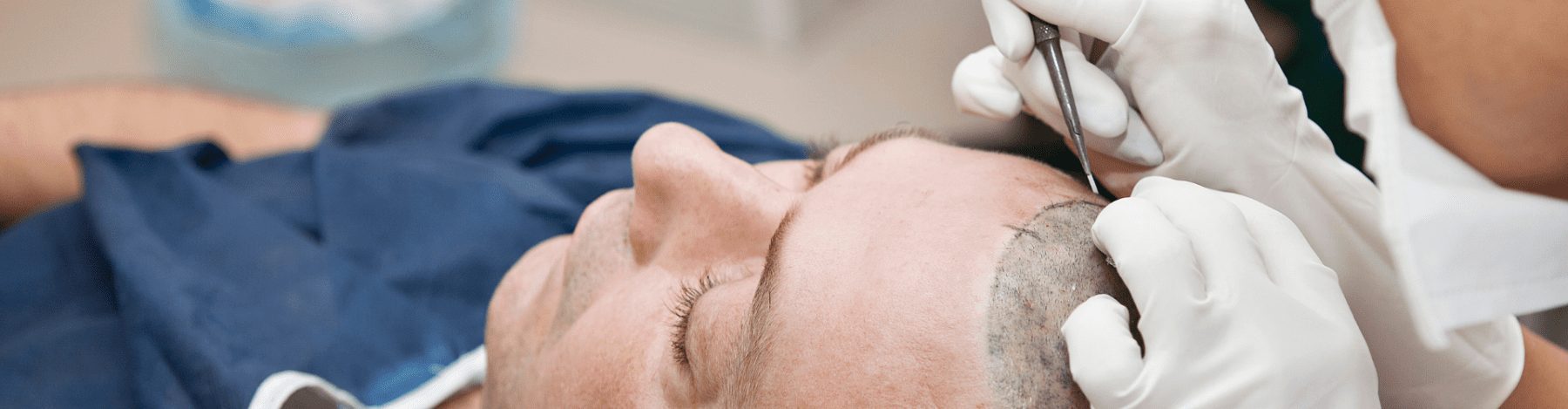 How to heal a hair transplant (2) How long will a hair transplant last