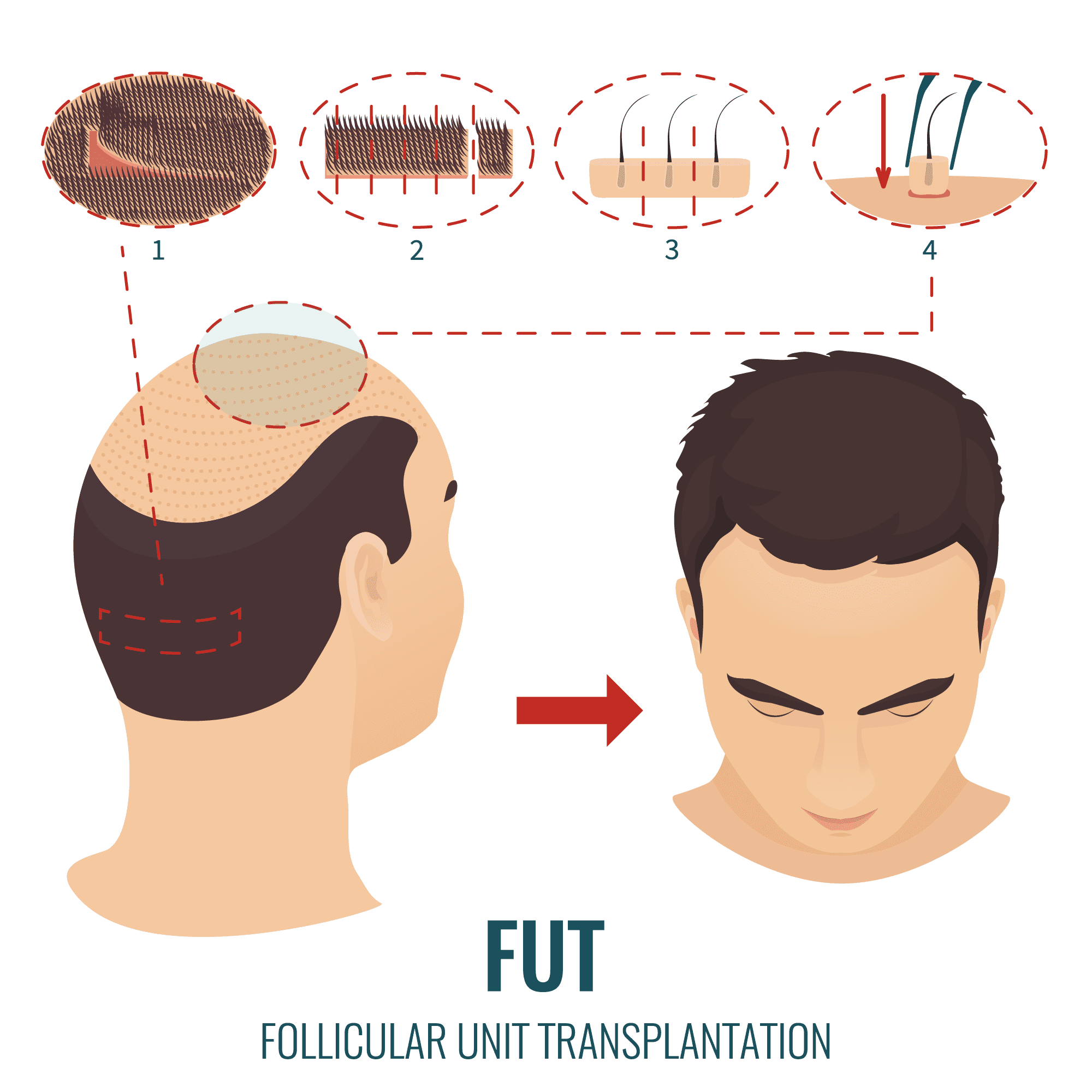 fut transplant process Nutrient Deficiency causes hair loss
