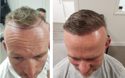 Laser hair growth | Low Level Laser Therapy | MHR Clinic Laser hair growth | Low Level Laser Therapy | MHR Clinic