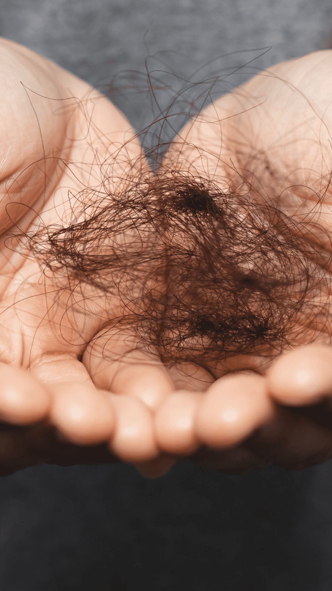 Hair falling out due to anti depression and ant depressant medication The increase in hair shedding and loss as a result of anti depressant drugs