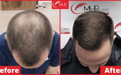 Laser hair growth | Low Level Laser Therapy | MHR Clinic